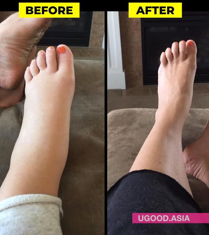 Home Remes For Swollen Ankles In Pregnancy Tutorial Pics